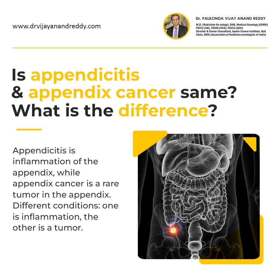 Dr_VijayReddy's tweet image. Appendix cancer involves abnormal cell growth in the appendix, often without symptoms until advanced stages. Seek medical advice for proper diagnosis.
#appendixcancer #appendicites #bestoncologist #cancerspecialist