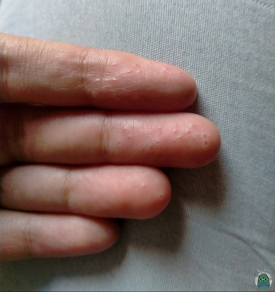 tw// disgusting 
💚 kalian ada ngga sih yg kena dishidrosis, aku bingung bgt ini dulu aku pernah, pas ke dokter dikasih salep eh malah makin banyak, pas didiemin ilang sendiri, sekarang kambuh lagi😭😭