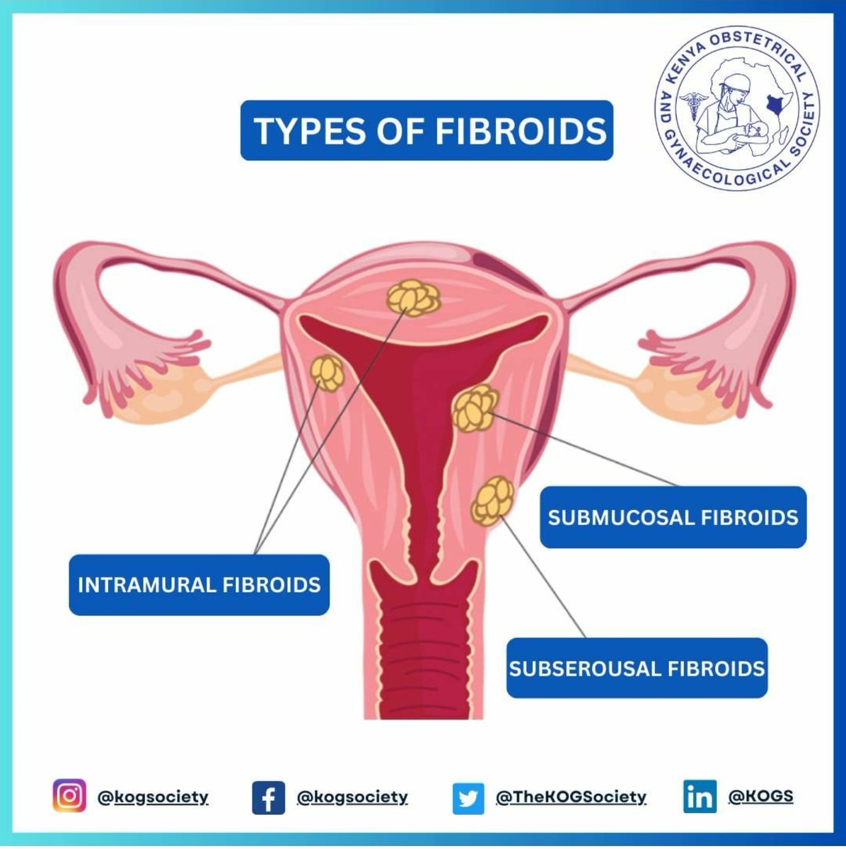 Unveiling the intricacies of fibroids: noncancerous growths in the uterus. Varying in size from tiny seedlings to sizable masses, fibroids are made of muscle and fibrous tissue presenting as solitary or clustered formations. Join the conversation #FibroidsAwareness #WomensHealth