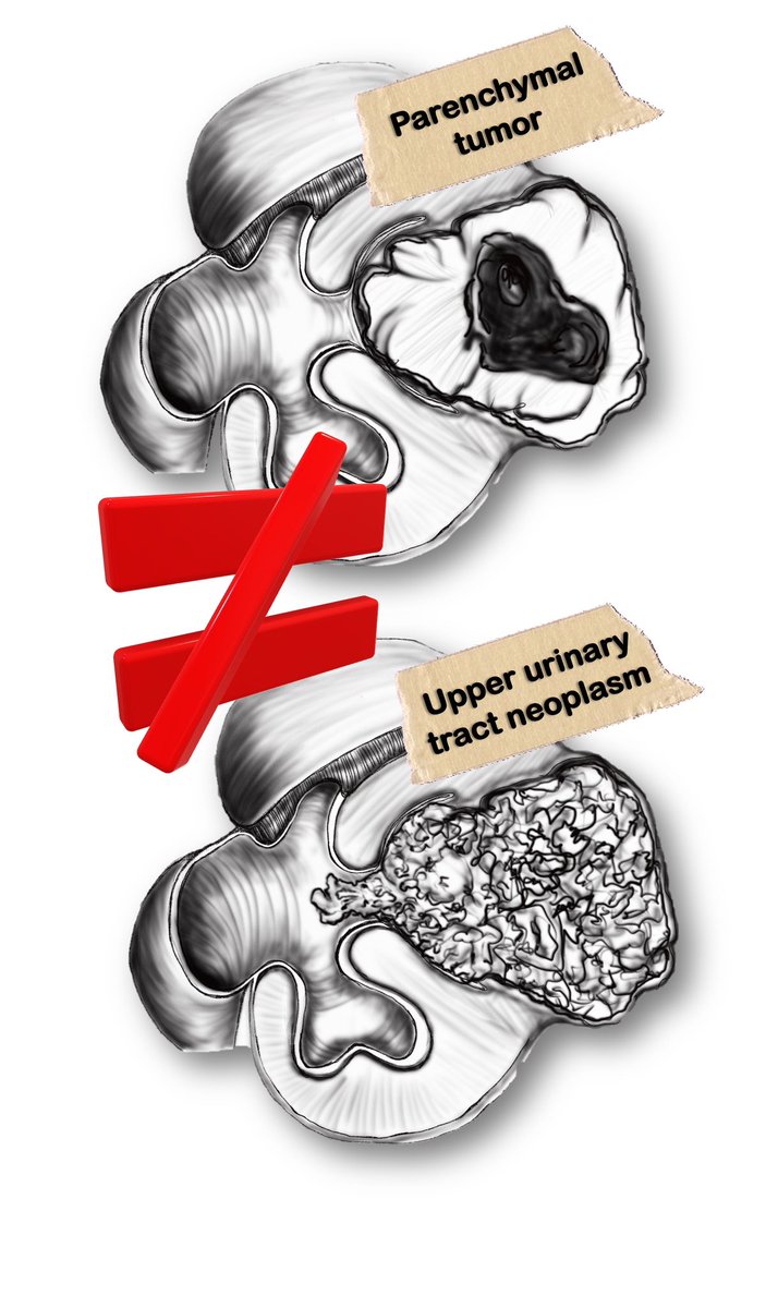 ART#3 - Kidney Cancer #UroSoMe @Uroweb