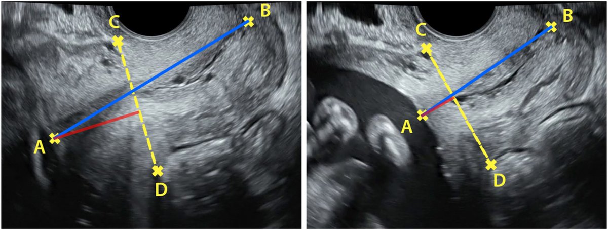 Real-time ultrasound demonstration of uterine isthmus contractions during pregnancy - Cervicoisthmic measurements in a contracted isthmus and a relaxed isthmus ow.ly/OLcc50PAJ2i