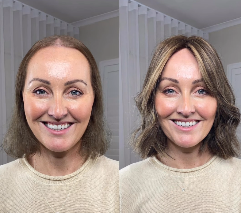 UniwigsC's tweet image. 💁‍♀️💃 Hair goals achieved effortlessly!
Hair topper featured:
8.5” x 9” Bob Melanie in 223R Mousse Brown
Shop link in the bio.
#hairtopper #hairtoppers #thinninghairsolution #hairtoppersforthinninghair #alopecia #hairloss #shorthairtoppers