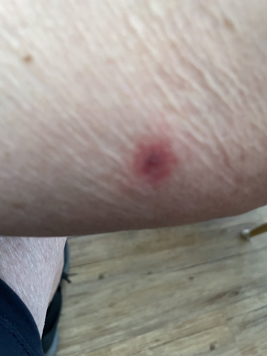 Ihr guten Leute, weiß jemand, was das ist, Flohbiss, Zeckenbiss oder?