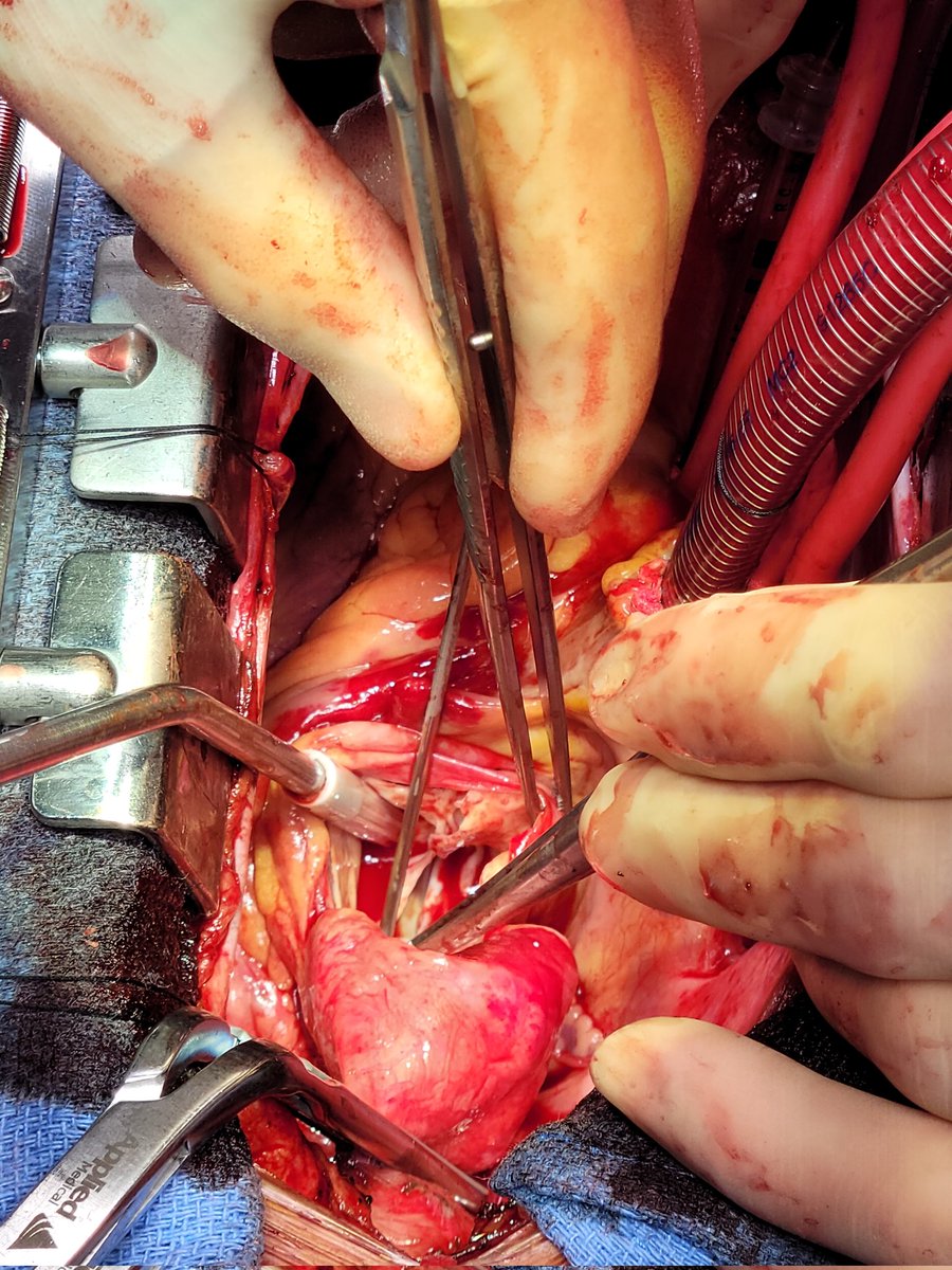 Tyler Wallen (@drtylerwallen) on Twitter photo Today is the first day of #aorticdissectionawareness month. Check out these accounts for more info: <a href="/THINK__AORTA/">THINK AORTA Global</a> <a href="/AorticHope/">Aortic Hope</a> <a href="/Run4AorticHlth/">RunforAorticHealth</a> <a href="/AorticDissectCT/">Aortic Dissection Charitable Trust</a> <a href="/AorticDissectUS/">Aortic Dissection US</a>
Ping: <a href="/geoarnaoutakis/">George Arnaoutakis</a> <a href="/IbrahimSultanMD/">Ibrahim Sultan</a> <a href="/KirstenAFreeman/">Kirsten Freeman</a> <a href="/dr_spratt/">John R Spratt, MD</a> @GeisingerVasc <a href="/GeisingerSurgEd/">Geisinger General Surgery Residency</a> Today is the first day of #aorticdissectionawareness month. Check out these accounts for more info: <a href="/THINK__AORTA/">THINK AORTA Global</a> <a href="/AorticHope/">Aortic Hope</a> <a href="/Run4AorticHlth/">RunforAorticHealth</a> <a href="/AorticDissectCT/">Aortic Dissection Charitable Trust</a> <a href="/AorticDissectUS/">Aortic Dissection US</a>
Ping: <a href="/geoarnaoutakis/">George Arnaoutakis</a> <a href="/IbrahimSultanMD/">Ibrahim Sultan</a> <a href="/KirstenAFreeman/">Kirsten Freeman</a> <a href="/dr_spratt/">John R Spratt, MD</a> @GeisingerVasc <a href="/GeisingerSurgEd/">Geisinger General Surgery Residency</a>