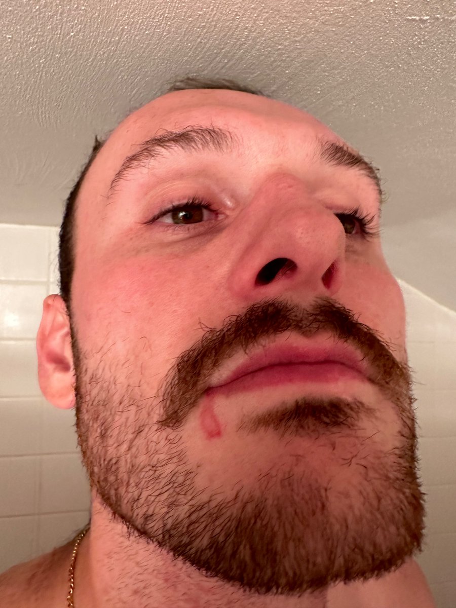 kaleyryan25's tweet photo. @Popeyes my husband got an apple pie 3 days ago and the molten lava apple filling burnt his his face up and people are asking if he has herpes. https://t.co/OK1k5wpBik