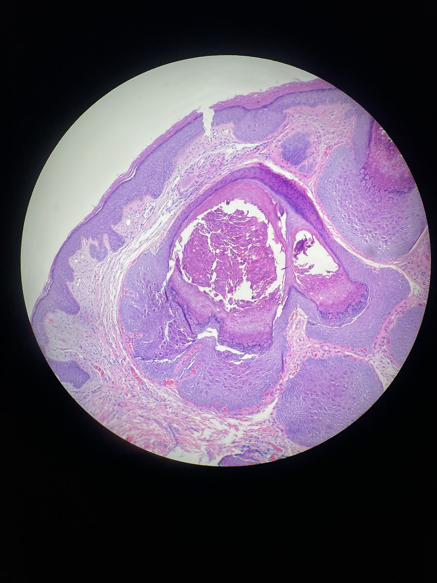 Perianal lesion. Clinical diagnosis: skin tag. What's your impression? Bonus points if you can name the eponym associated with these "bodies"