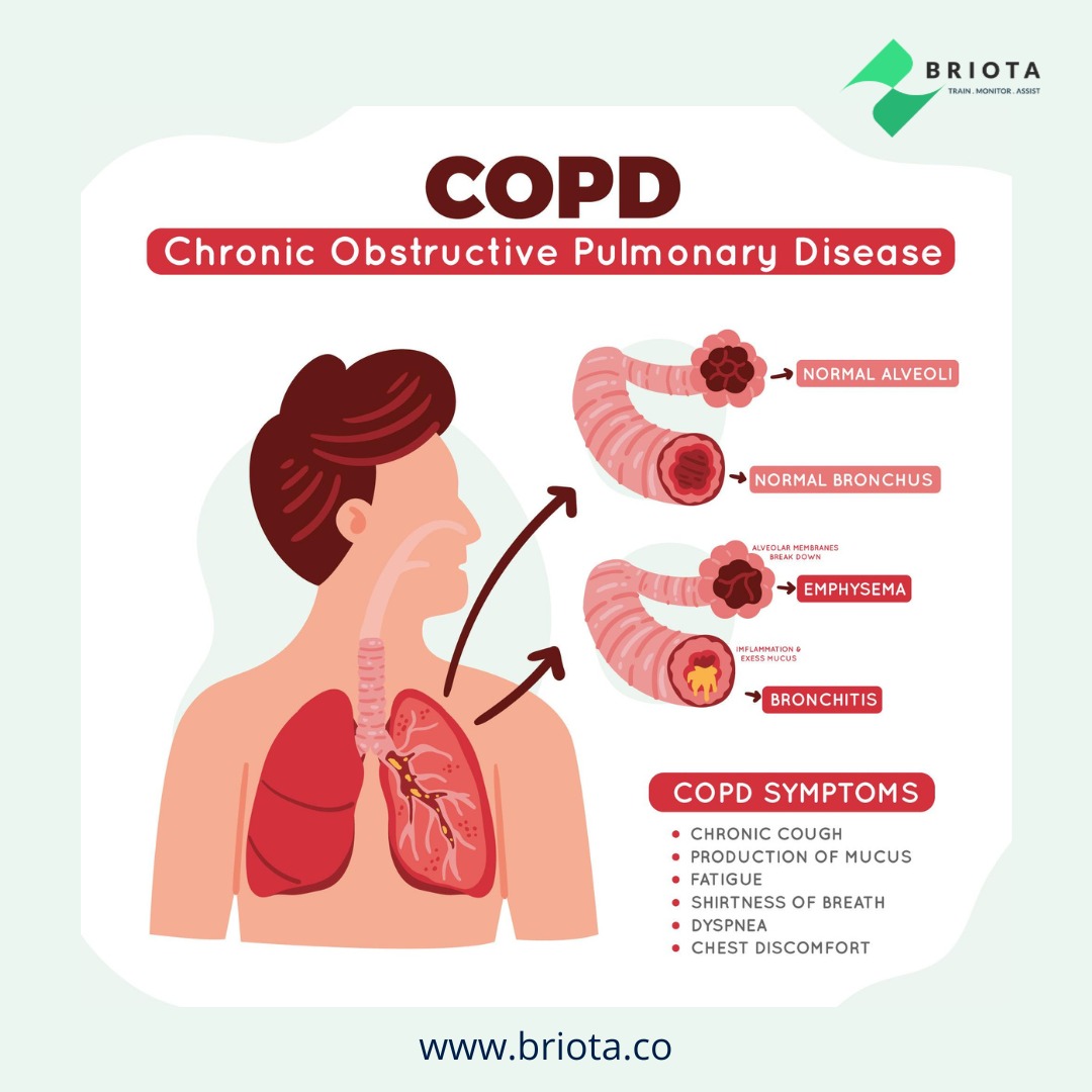 Learn to recognize the early signs of Chronic Obstructive Pulmonary Disease (COPD) and take control of your lung health.

Spread awareness and support those affected. 💙 briota.co

#COPDawareness #BreatheEasy #LungHealthMatters #Lungs #COPD