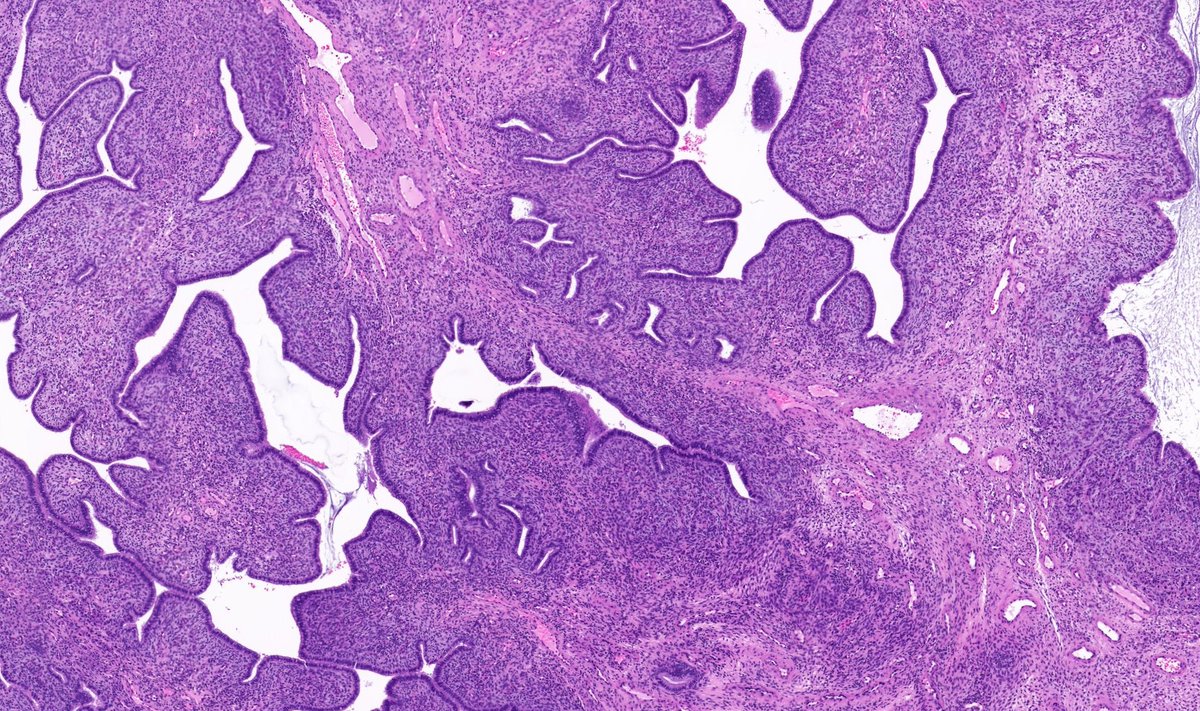 TristanRutland7's tweet photo. Cervix, adult

A quick follow up case and quiz from last weekends #DiagnexiaSymposium2023

#Gynpath #GUpath #GIpath #HPBpath #Pathresidents #Pathtwitter https://t.co/thGT6bIk2y