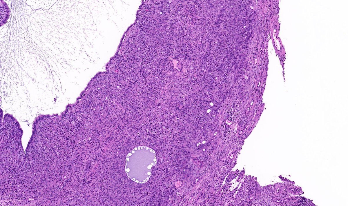 TristanRutland7's tweet photo. Cervix, adult

A quick follow up case and quiz from last weekends #DiagnexiaSymposium2023

#Gynpath #GUpath #GIpath #HPBpath #Pathresidents #Pathtwitter https://t.co/thGT6bIk2y