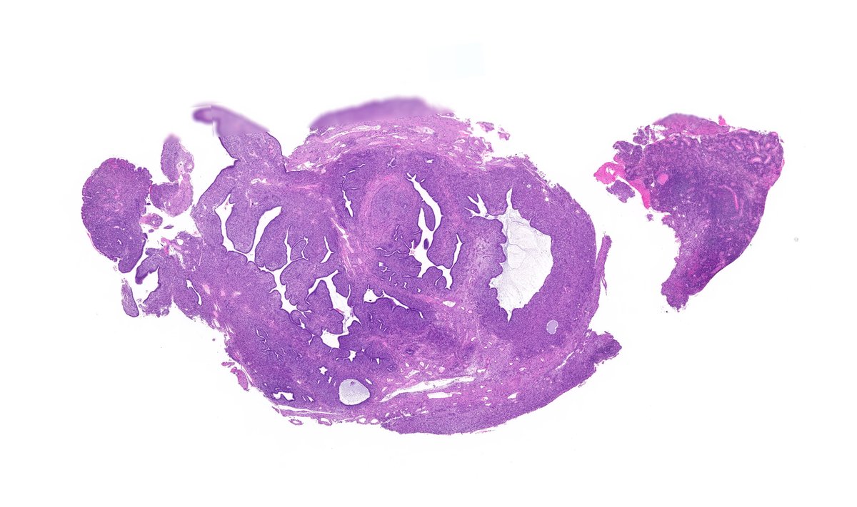 TristanRutland7's tweet photo. Cervix, adult

A quick follow up case and quiz from last weekends #DiagnexiaSymposium2023

#Gynpath #GUpath #GIpath #HPBpath #Pathresidents #Pathtwitter https://t.co/thGT6bIk2y