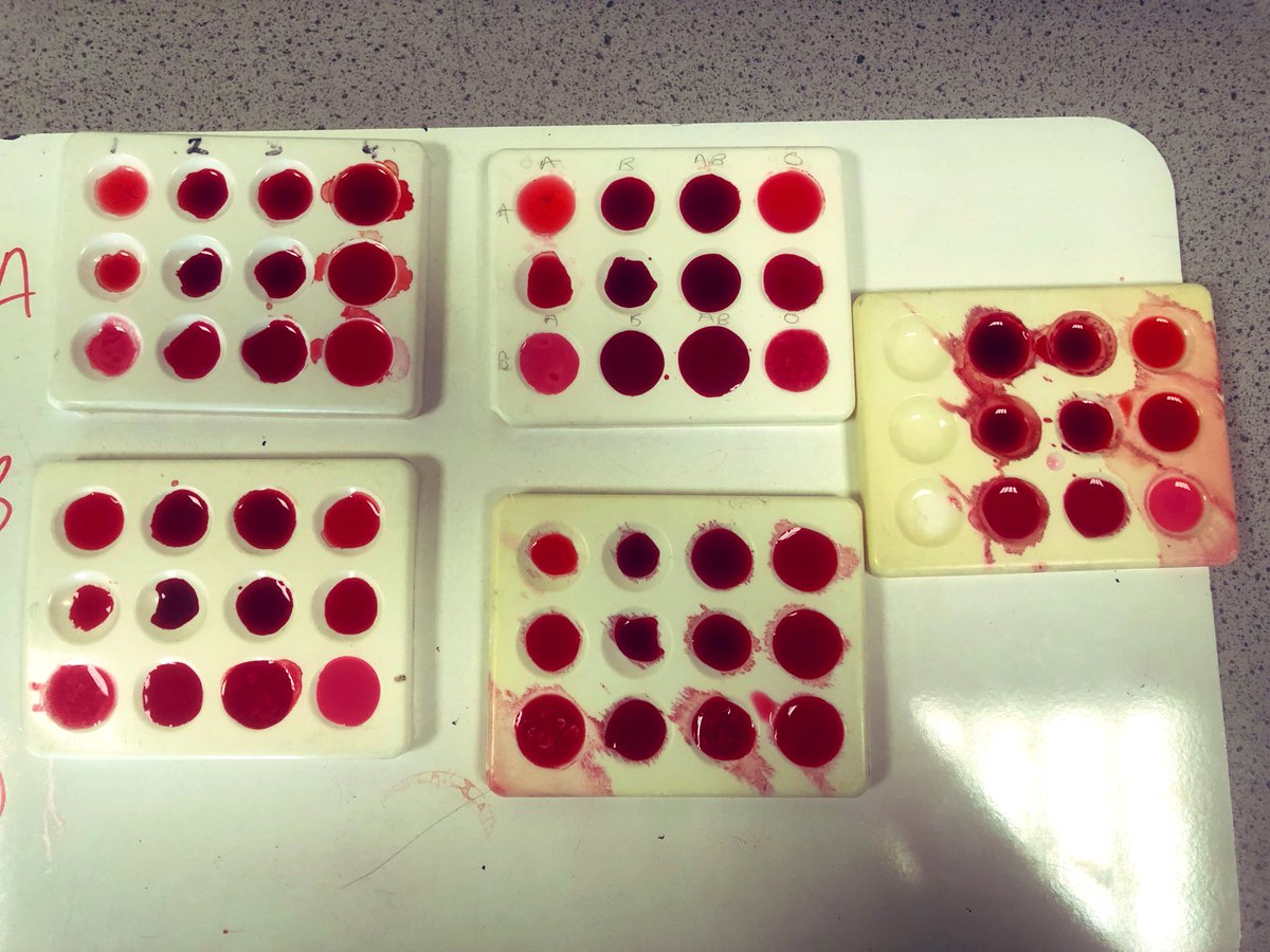 OHara_Biology's tweet photo. 2T were investigating which blood groups are compatible and which coagulate (form clumps) when combined. Great work and we will discuss the results and findings next lesson! 🩸 🩸 @amygoo27 #S2superstars #blood #biology #topicalscience https://t.co/yyz263iPZY