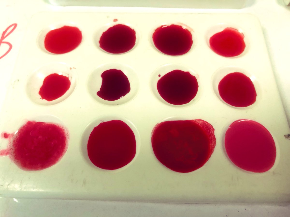 OHara_Biology's tweet photo. 2T were investigating which blood groups are compatible and which coagulate (form clumps) when combined. Great work and we will discuss the results and findings next lesson! 🩸 🩸 @amygoo27 #S2superstars #blood #biology #topicalscience https://t.co/yyz263iPZY