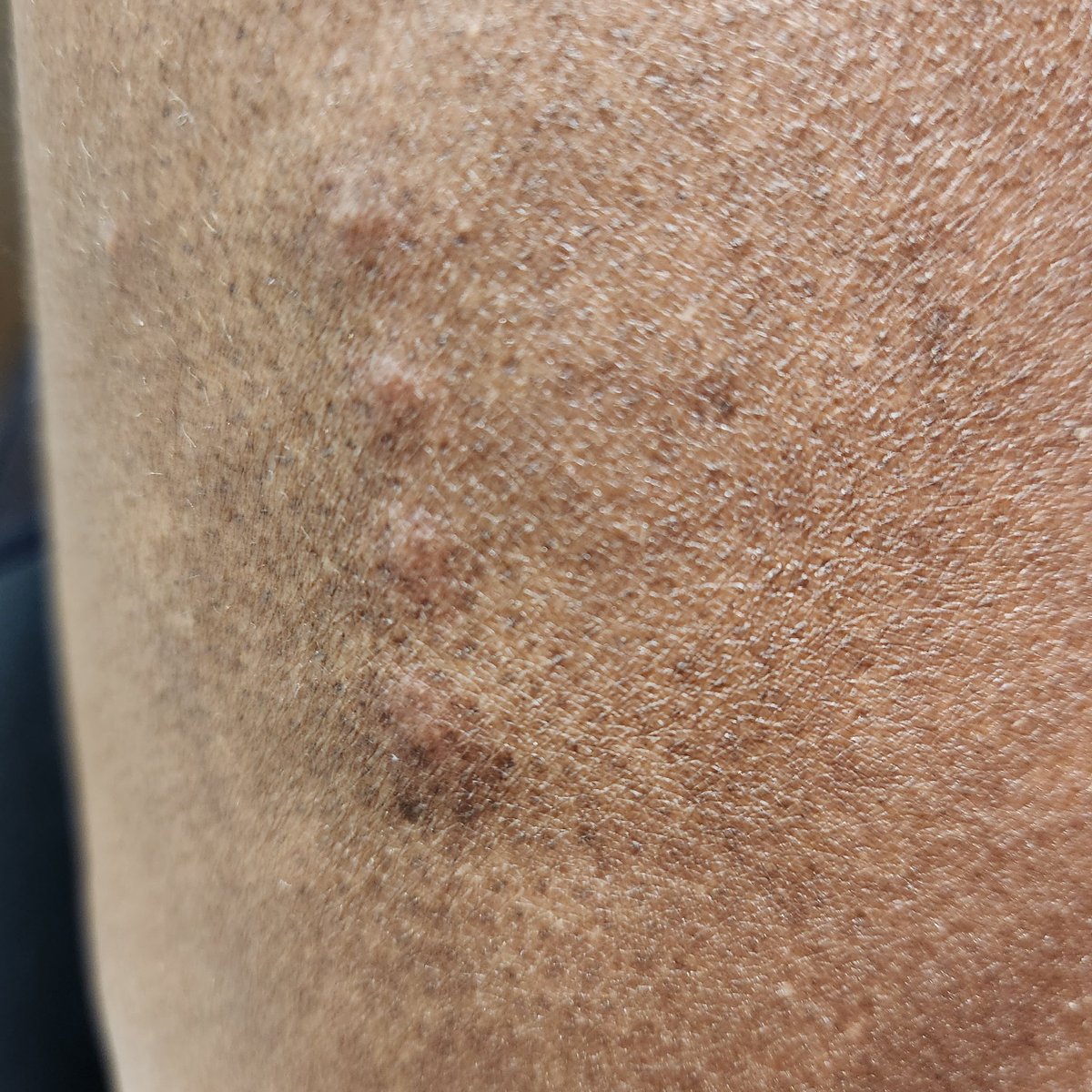 artishill's tweet photo. Just had the worst experience at Holiday Inn in downtown Brooklyn. My mom was bit by bed bugs. Hotel management response was horrible. I would expect better service. @IHGCorporate @IHGhotels @HolidayInn https://t.co/wlzQwCI3Yu