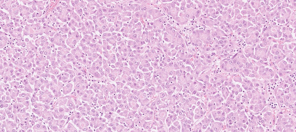 50ish y/o male, large adrenal mass, no hormone production, adrenal cortical carcinoma suspected from preoperative imaging. Histology: tumor with trabecular to lobular growth, mild nuclear atypia and pale eosinophilic cytoplasm. Ring a bell? More images in thread: