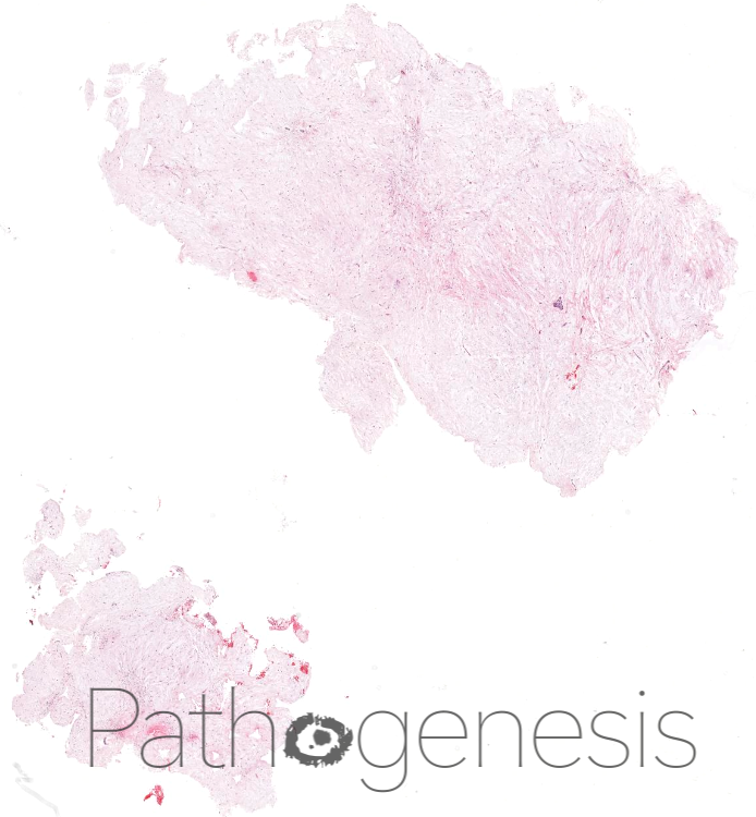 @theBSOMP Case of the Month for Sep/Oct 23 is now live. Visit bsomp.org.uk/cotm for history, wholeslide image, diagnosis & learning points. WSI credit- @pathogenesisDP pathogenesis.org.uk #bsomp #COTM #oralpathology #pathology #headandneckpathology