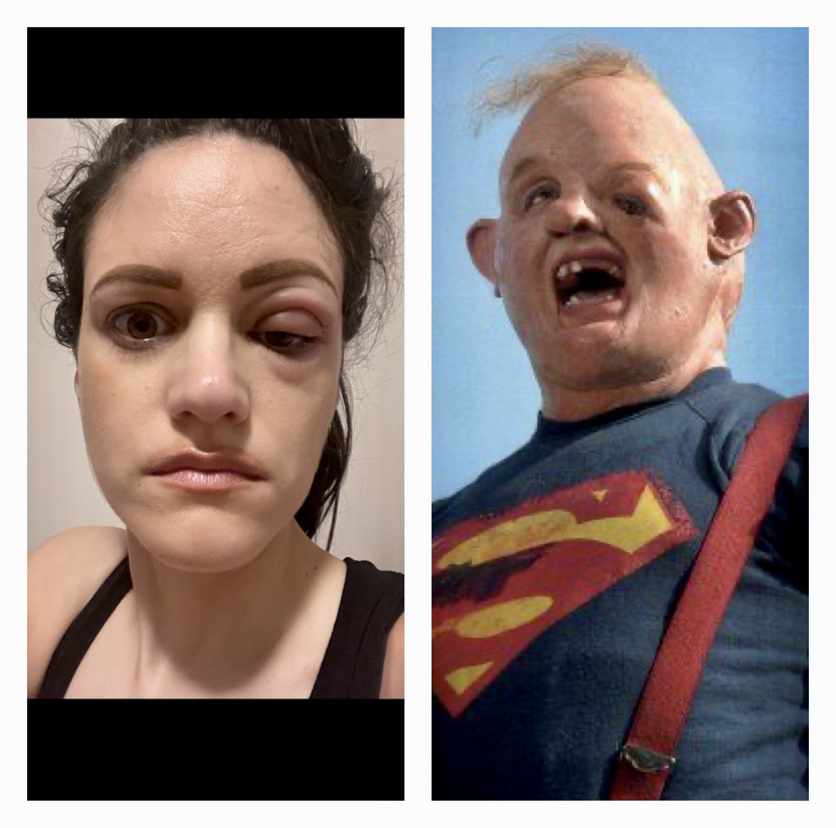 nataliegparsons's tweet photo. Happy THURSDAY!
Now I know who I look like…
The GOONIES’s SLOTH 😂😂😂
#allergicreaction #antbite
#cantmakethisup #noshame https://t.co/is0fyQIdSM