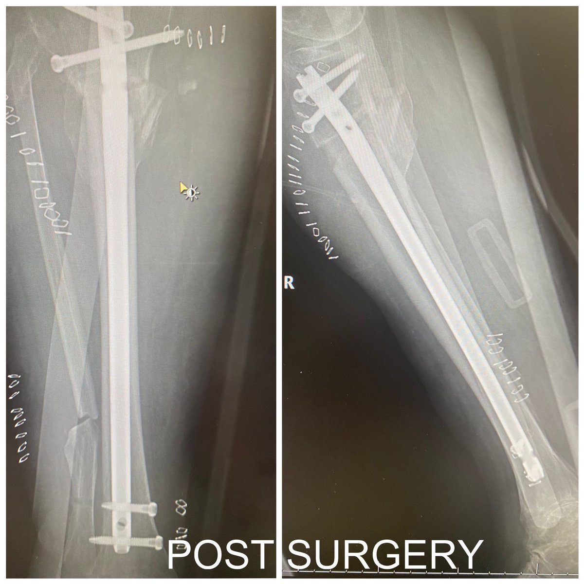 Surgical guide in case of bilateral advanced gonarthrosis and fracture in varum and antecurbatum of right tibia by SLA technology in biocompatible resin (IIa) to correct extra-articular deformity <a href="/3d_maranon/">FabLab 3D Hospital Marañón</a> <a href="/rupermac/">Rubén Pérez-Mañanes, MD PhD</a> <a href="/calvoharo_ja/">José Antonio Calvo</a> #UPAM3D #HospitalGregorioMarañon #impresion3D