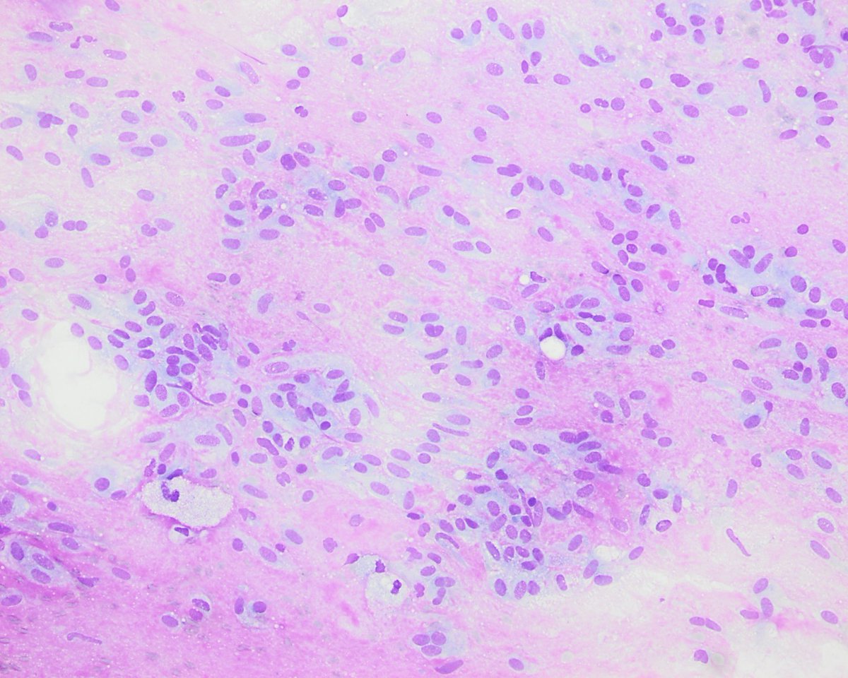 pepeheffernan's tweet photo. CC293. In her 70s, renal tumor. I knew this tumor. In fact I liked it, but I had no cytologic experience. Neither did my mentor. I sent it to her (Dr. Blanca Vicandi) because I didn't know what it was. She instantly replied, "this must be a ...."
Mentors are smarter #cytopath https://t.co/FFJ866ucwT