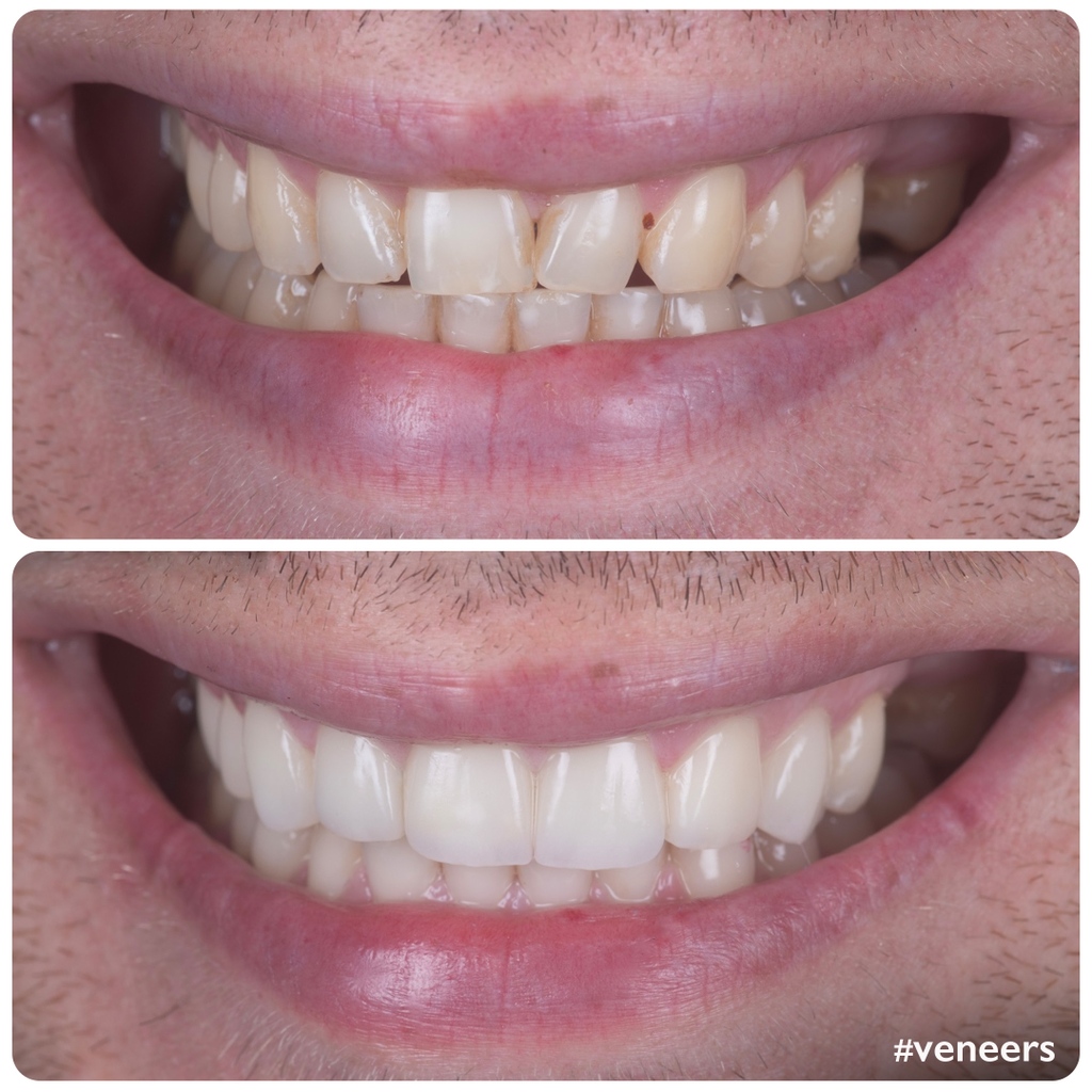 doctor_michaels's tweet image. #SmileTransformed with #VENEERS!

Thanks to the deft work of our #dentalexpert, Dr. Khalid Aldabbas, using six #feldspathicveneers, the patient got his #smile back.

These veneers were also used to conceal his missing #fronttooth, giving a renewed #charm to this patient's smile.
