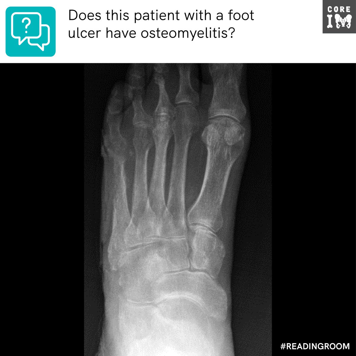 1/ 🚨Your patient with a foot ulcer gets this X-ray!🚨 Do they have osteomyelitis?!