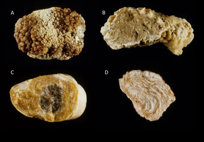 Throwback Thursday: Classification of Stones According to Michel Daudon: A Narrative Review 

buff.ly/47KUbOc 

<a href="/_MCorrales_/">Mariela Corrales</a> <a href="/YazBarghouthy/">Yazeed Barghouthy</a> <a href="/OTRAXER/">Olivier Traxer</a> 

#ThrowbackThursday #UroSoMe #Medtwitter
