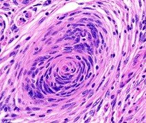 EsmaeilX's tweet photo. Nothing is more illusive than the whorls of a #meningioma. It's like a water vortex that draws you down in the nightmares! https://t.co/zFG9fJhfSy