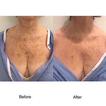 Laser treatments are very effective. This lovely patient had a laser treatment on her breasts and face and she was ecstatic with the results! New image 😊 #MedicalBeauty #Plastic Surgery Topics