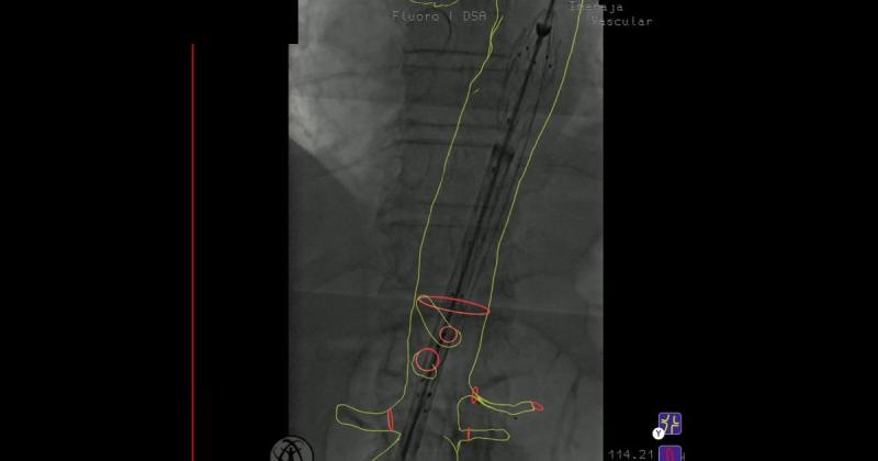 Vascupedia_com's tweet photo. #ThrowbackThursday @ #Vascupedia
🎥 Treatment of an 83mm juxtarenal aortic aneurysm
Use of @CydarMedical EV Maps to guide the embolization of the upper left renal artery followed by #BEVAR.
https://t.co/FH0NaDWztd
#AI #AAA #AortaED
@farkomd @AWBeckMD @AortaSurg @ErbenYoung https://t.co/bhALDn1UOA
