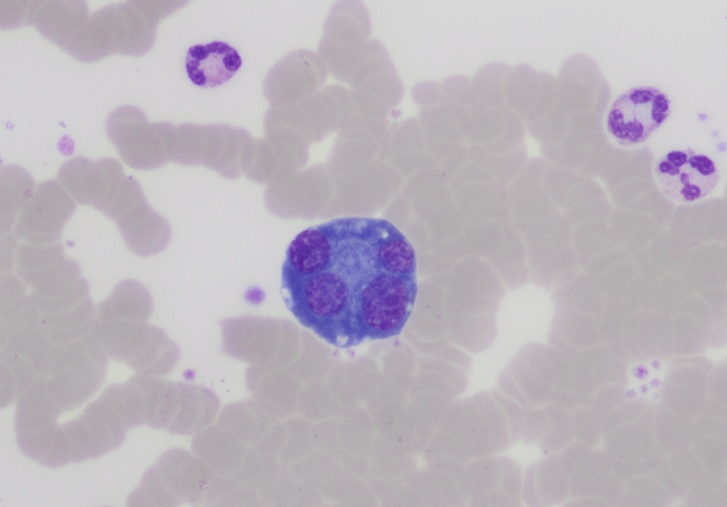 There's atypical plasma cells, and then this guy.