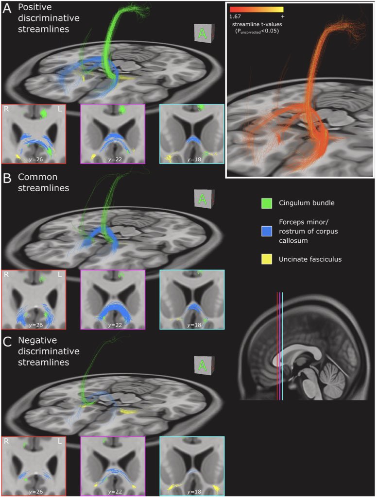 Andreas Horn (@andreashorn_) on Twitter photo Thought to highlight two recent <a href="/brainstimj/">Brain Stimulation</a> papers that deserve special mention:
First is a report by the Toronto team showing that left cingulate (and not right (!)) seems key to modulate in Cg25 DBS for depression.
100% fits my (unpublished) results.
clinicalkey.com/#!/content/pla… Thought to highlight two recent <a href="/brainstimj/">Brain Stimulation</a> papers that deserve special mention:
First is a report by the Toronto team showing that left cingulate (and not right (!)) seems key to modulate in Cg25 DBS for depression.
100% fits my (unpublished) results.
clinicalkey.com/#!/content/pla…