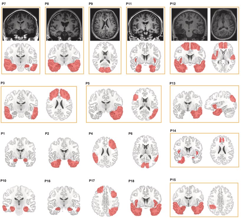 Second is a paper by Liankun Ren’s team showing that in focal epilepsy, functional connectivity between the (ANT) DBS stimulation volume and the seizure onset zone accounts for seizure reductions. (disclosure am a co-author on that one).

authors.elsevier.com/sd/article/S19…