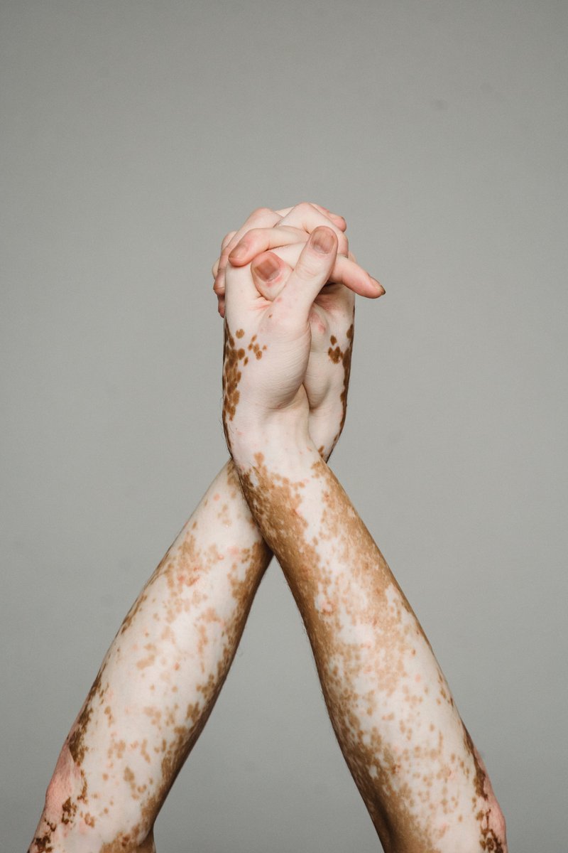 Did you know?

Vitiligo is considered an autoimmune condition, where the body's immune system mistakenly attacks and destroys the cells responsible for skin pigmentation.