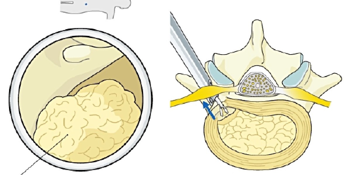 AOSurgery's tweet photo. Exciting news for #SpineSurgeons 🌟 Explore the world of minimally invasive surgery (MISS) treatments for degenerative cervical and lumbar spine conditions. Read more here ➡️ https://t.co/UcG5eNwOjN
#AOReference #AOSpine #MedicalInnovation https://t.co/yNsMyPg7GE