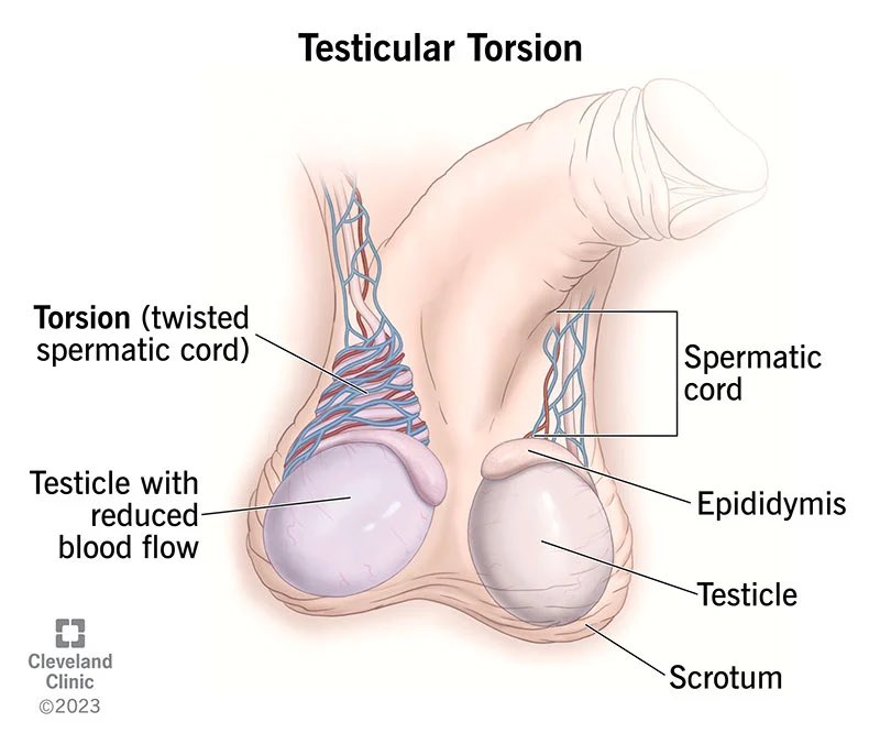 Testicular torsion is the most common cause of testis loss in the US. The salvage rate is 100% if detorsion occurs within 6 hours of the onset of pain. After 24 hours, there is pretty much no viability.