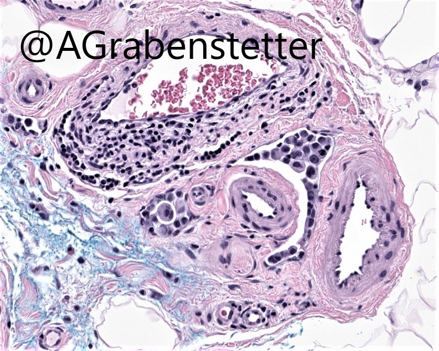 Breast path poll: Asking #pathtwitter if they quantify the amount of LVI in their breast resection specimens. If so, which definition do you use? 
#BreastPath #bcsm #pathology #breastcancer

See poll 👇