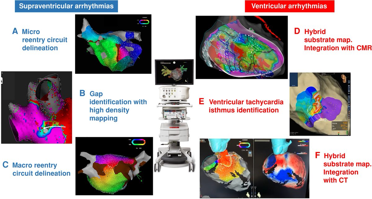Europace Editor-in-Chief (@europaceeic) on Twitter photo ⚡️check this review from the📷25 years #Europace issue #EPeeps
Twenty-five years of research in cardiac imaging in EP procedures for atrial and ventricular arrhythmias
📑doi.org/10.1093/europa…
<a href="/GiulioConte9/">Giulio Conte</a> <a href="/marcovitoloMD/">Marco Vitolo Ⓜ️</a> <a href="/Dominik_Linz/">Dominik Linz</a> <a href="/FraSantoroMD/">Francesco Santoro, MD, PhD</a> <a href="/AndyZhangMD/">Xiaodong Zhang (Andy), MD, PhD, FHRS, FACC</a> <a href="/ESC_Journals/">European Society of Cardiology Journals</a> ⚡️check this review from the📷25 years #Europace issue #EPeeps
Twenty-five years of research in cardiac imaging in EP procedures for atrial and ventricular arrhythmias
📑doi.org/10.1093/europa…
<a href="/GiulioConte9/">Giulio Conte</a> <a href="/marcovitoloMD/">Marco Vitolo Ⓜ️</a> <a href="/Dominik_Linz/">Dominik Linz</a> <a href="/FraSantoroMD/">Francesco Santoro, MD, PhD</a> <a href="/AndyZhangMD/">Xiaodong Zhang (Andy), MD, PhD, FHRS, FACC</a> <a href="/ESC_Journals/">European Society of Cardiology Journals</a>