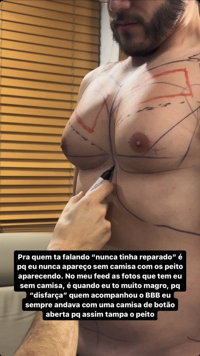 centralreality's tweet photo. 🚨VEJA: Ex-BBB Eliezer compartilha resultado da cirurgia de retirada das mamas e lipoaspiração. https://t.co/iUPv5PQSgm