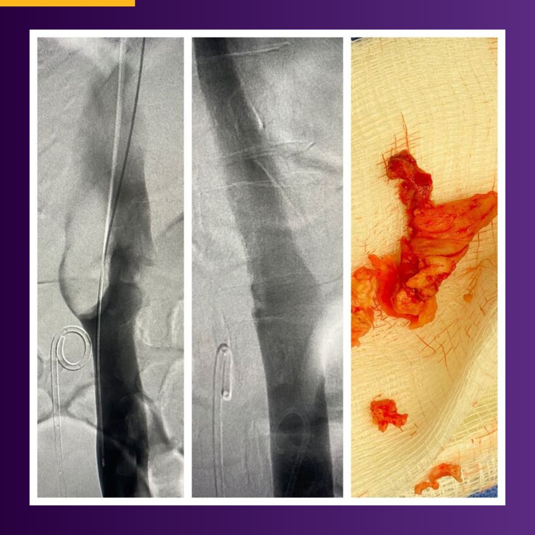 Patient presented with organized #clot in the suprarenal IVC. Dr. Sabah Butty used #ClotTrieverXL to pull the clot out in 4 passes total, removing most in the first 2 passes, through the 16 Fr #ClotTriever sheath in common femoral vein access.