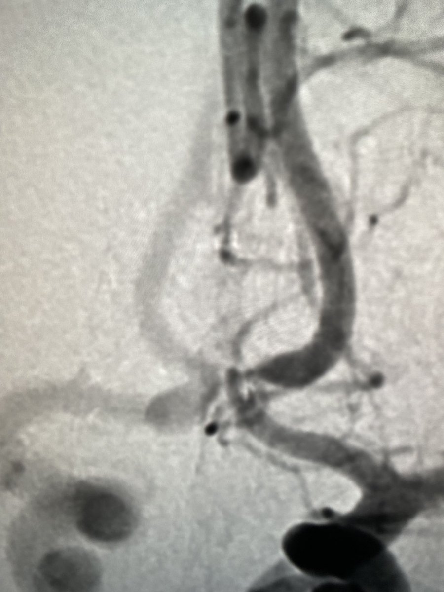 Boise Neurointervention (@stlukesnir) on Twitter photo Anvil-shaped 11mm AComm aneurysm, t/w WEB 10x5. No residual filling, see ya! <a href="/EricRSmithMD/">Eric R Smith</a> @MV_Terumo <a href="/sbuzzell10/">Steve buzzell</a> Anvil-shaped 11mm AComm aneurysm, t/w WEB 10x5. No residual filling, see ya! <a href="/EricRSmithMD/">Eric R Smith</a> @MV_Terumo <a href="/sbuzzell10/">Steve buzzell</a>