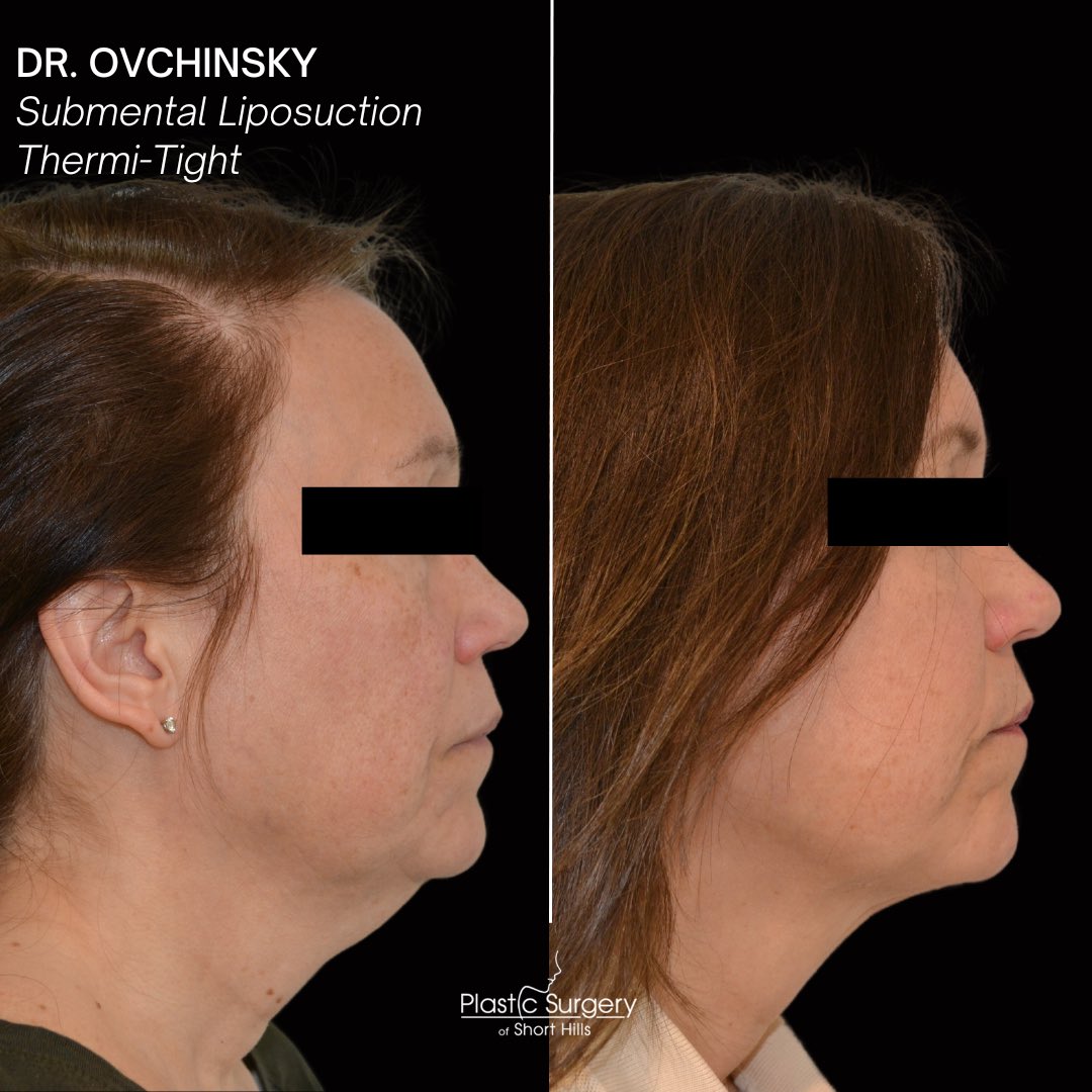 DrOvchinsky's tweet photo. Looking to tighten your jawline, jowls, and lower face without undergoing surgery? Submental Liposuction with Thermi-Tight is the ultimate duo to tighten &amp; lift the skin to achieve a more youthful, defined look.Interested? Call us for more details!⏩️ (973)-379-0101 https://t.co/YJhqng0Xou