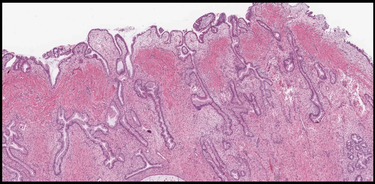 What would you call this? Would you even comment? Answer: kikoxp.com/posts/9504 More posts from Dr. Hassell @HassellLewis kikoxp.com/lewis_a_hassel… #pathology #pathTwitter #medTwitter #gynpath