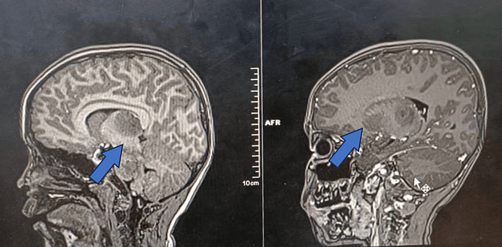 CureusNeuro's tweet photo. 🧠 Exploring Positive Outcomes in Children's Acute Necrotizing Encephalitis Post-SARS-CoV-2 🏥👩⚕️ New Insights for Physicians. 👉 https://t.co/ZOWbBscEfu
📚 #PediatricNeurology #COVID19Research #MedicalFindings https://t.co/pfrBTLyRcH
