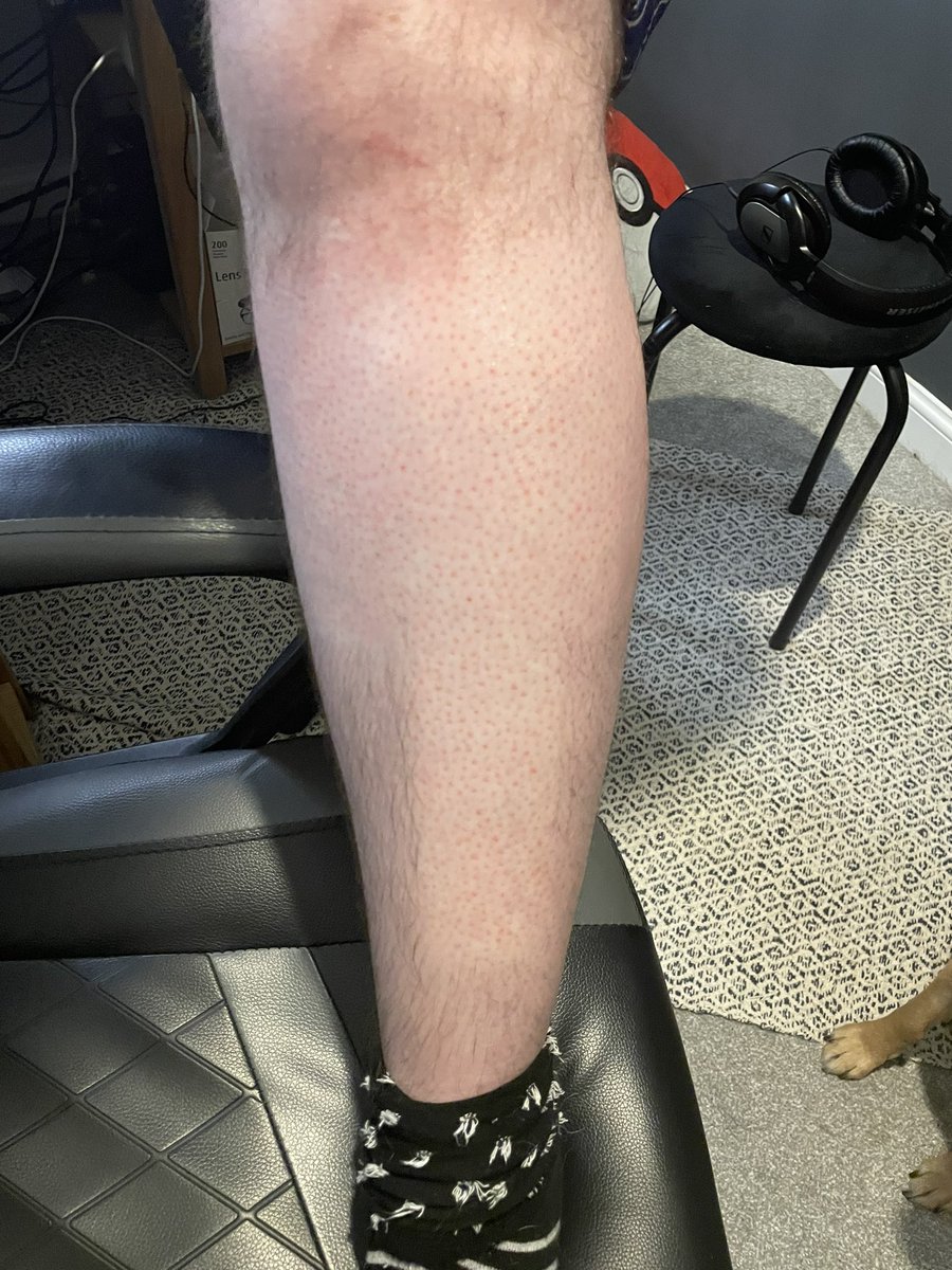 MrDuwiol's tweet photo. Thank you so much to everyone for helping raise $2500 so far for the American Foundation for Suicide Prevention! My legs are much smoother but it was for a fantastic cause! https://t.co/BjEgBFhtmA
