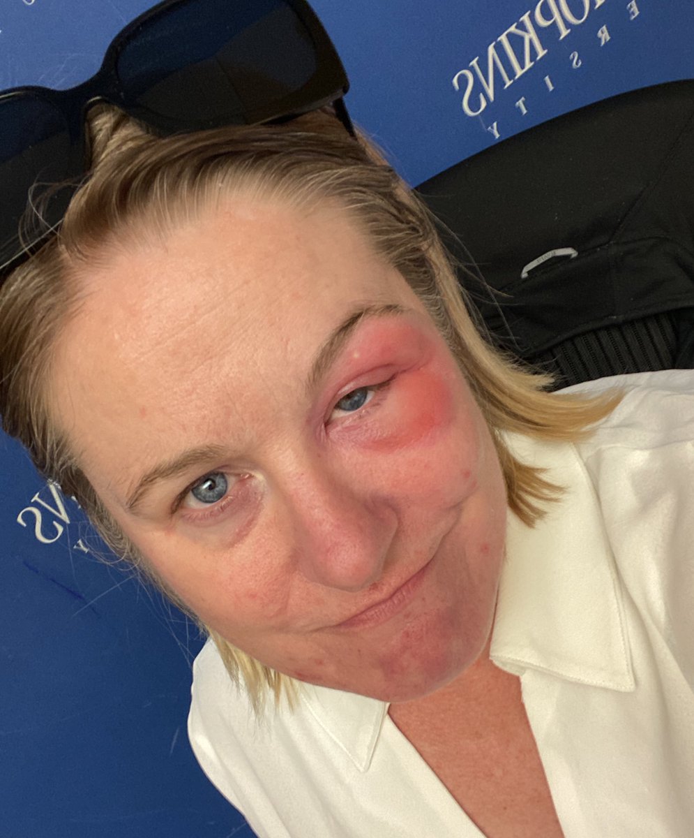 If you think you’re having a bad day today… just know that I am right there with you, walking around looking like this. #bugBiteOnTheEye #allergicReaction #callingItADay #benadrylSaveMe