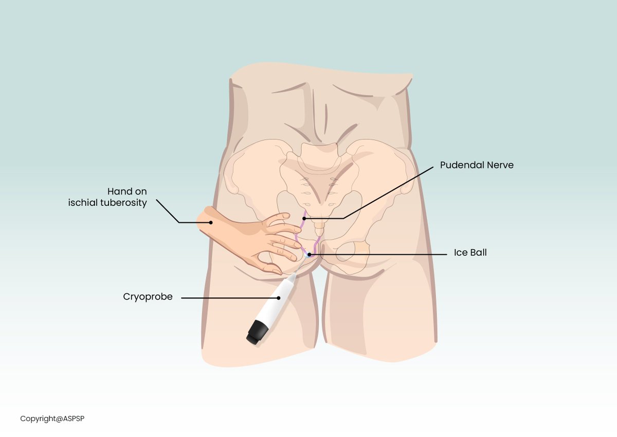 Cryoneurolysis of Pudendal nerve is a promising modality that can offer long term pain relief in patients with pelvic pain. Here is our article on the technical description 👉cureus.com/articles/15903… #pelvicpain #pudendalneuralgia #cryoneurolysis #tampapainmd @ASPSP_Pain