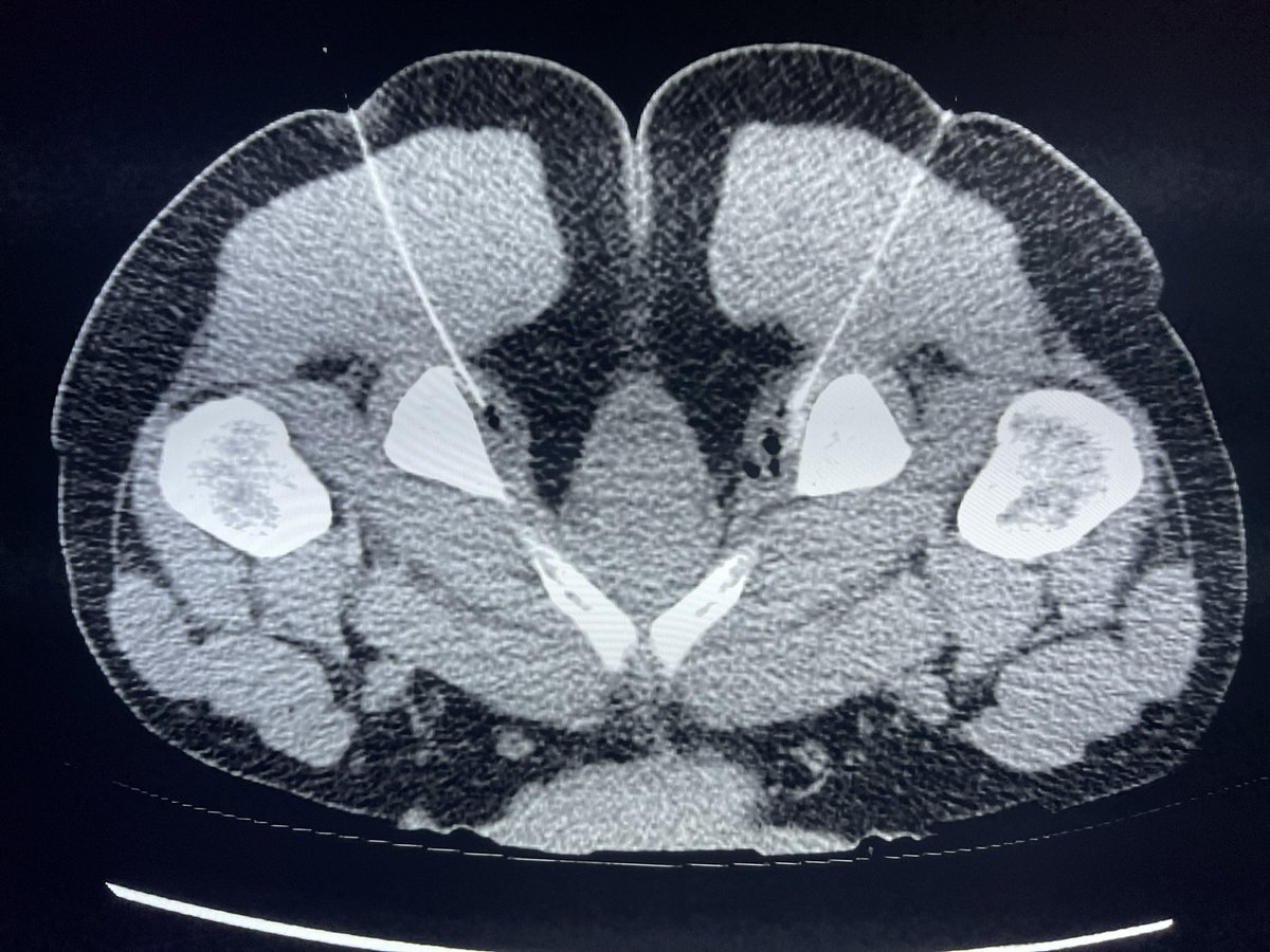 More #MSKIR - pudendal nerve block in a patient with chronic perineal pain. 

Ropivacaine and steroid into the bilateral pudendal canal. 

If it is successful, but not for long enough, will do #cryoneurolysis per the @jdprologo protocol.