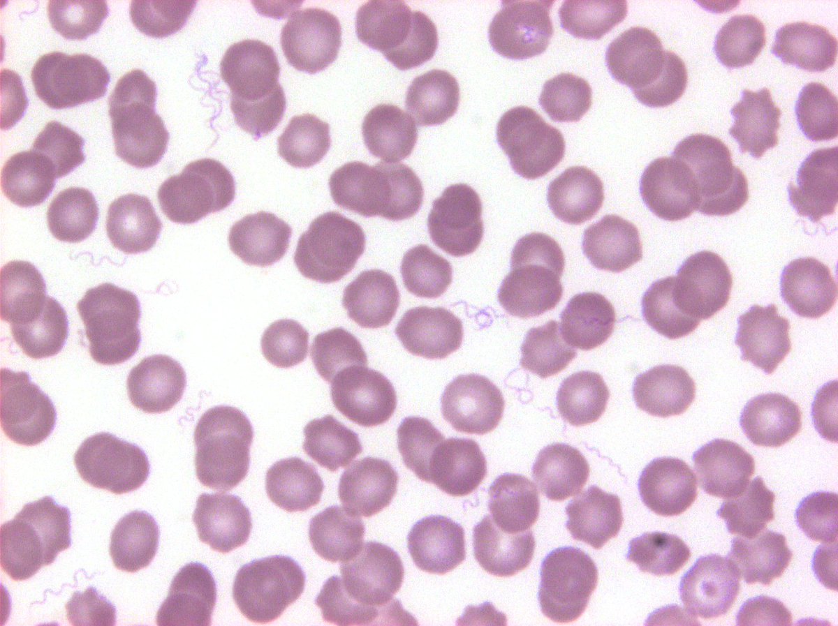 #hemepath Relapsing fever - Borrelia recurrentsis