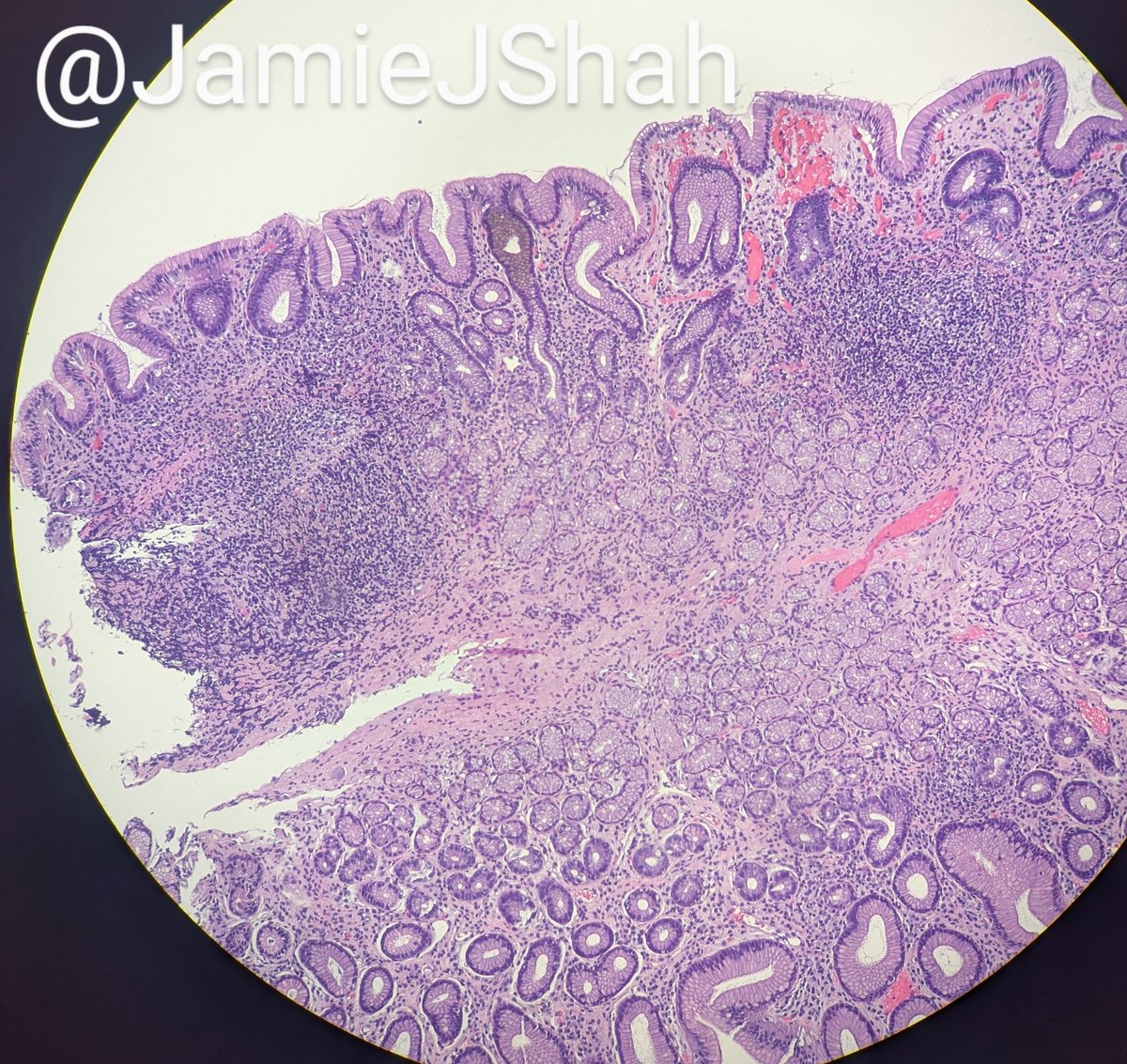 JamieJShah's tweet image. 17M, Reflux sx refractory to PPI therapy. EGD showed nodular antral mucosa. Random stomach biopsy with chronic gastritis, lymphoid aggregates #pedipath #gipath #idpath