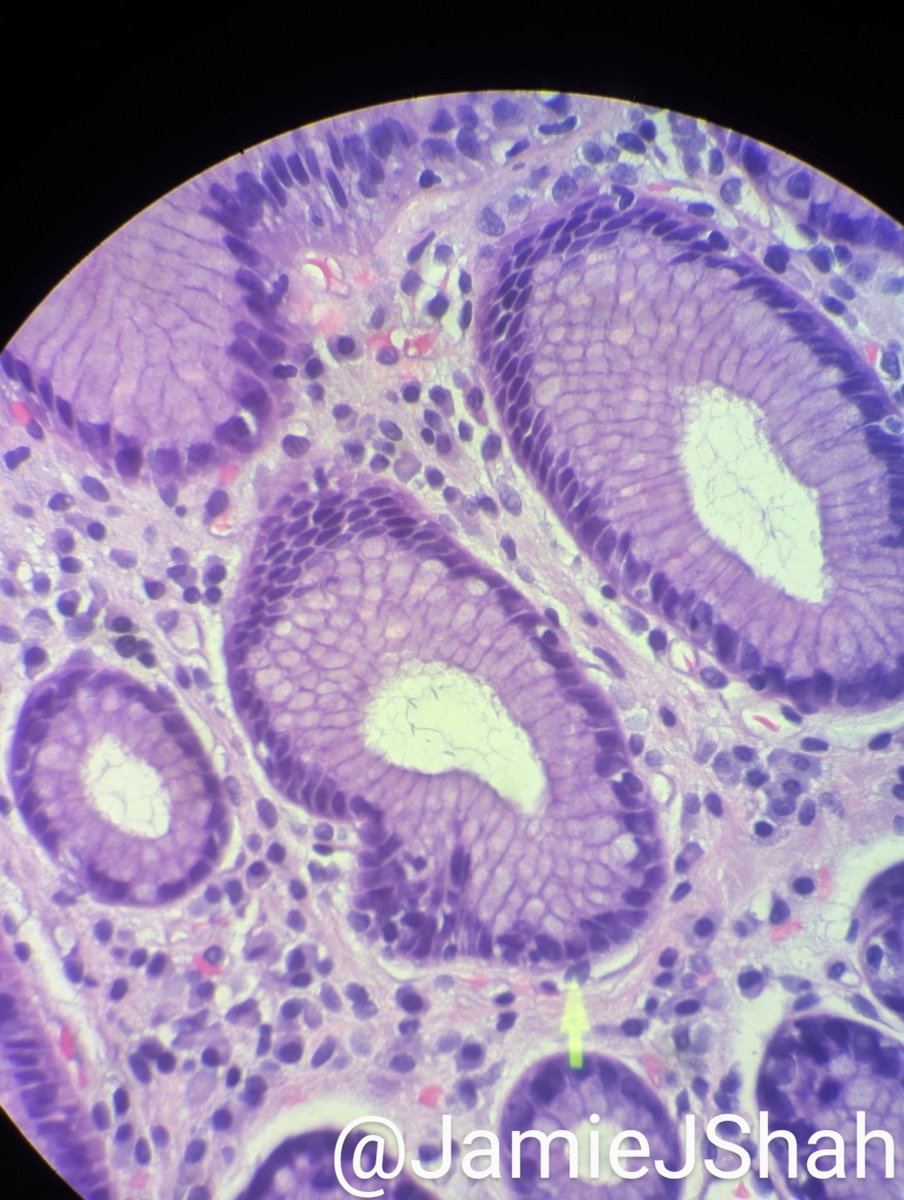 JamieJShah's tweet image. 17M, Reflux sx refractory to PPI therapy. EGD showed nodular antral mucosa. Random stomach biopsy with chronic gastritis, lymphoid aggregates #pedipath #gipath #idpath