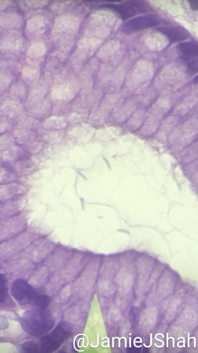 JamieJShah's tweet image. 17M, Reflux sx refractory to PPI therapy. EGD showed nodular antral mucosa. Random stomach biopsy with chronic gastritis, lymphoid aggregates #pedipath #gipath #idpath